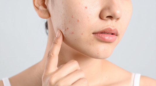 Close-up of a woman’s lower face with visible acne on the cheek and jawline, touching her skin thoughtfully.