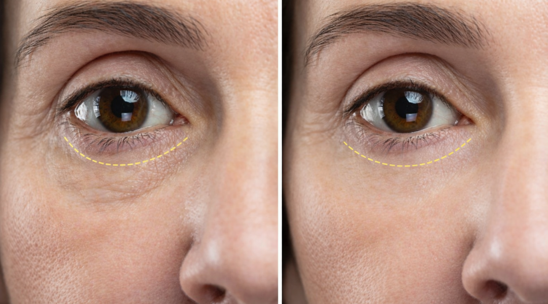 Side-by-side close-up of a woman’s under-eye area showing puffiness and visible swelling on the left, and reduced puffiness with a smoother, more refreshed appearance on the right after consistent facial massage.