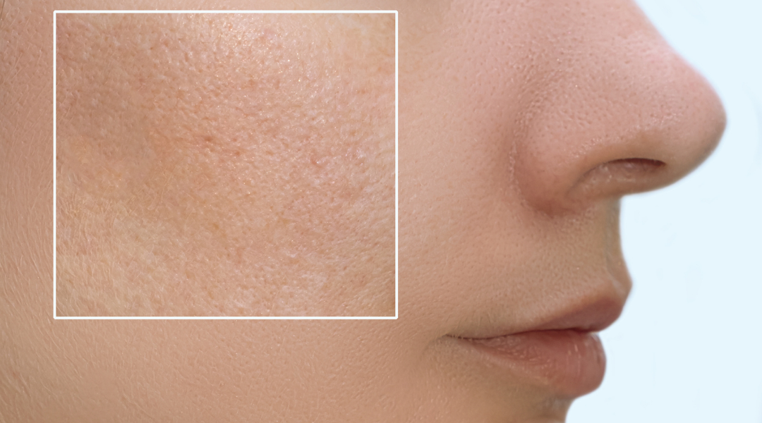 Close-up of enlarged pores on the cheek area, illustrating how skin imbalance can affect pore appearance.